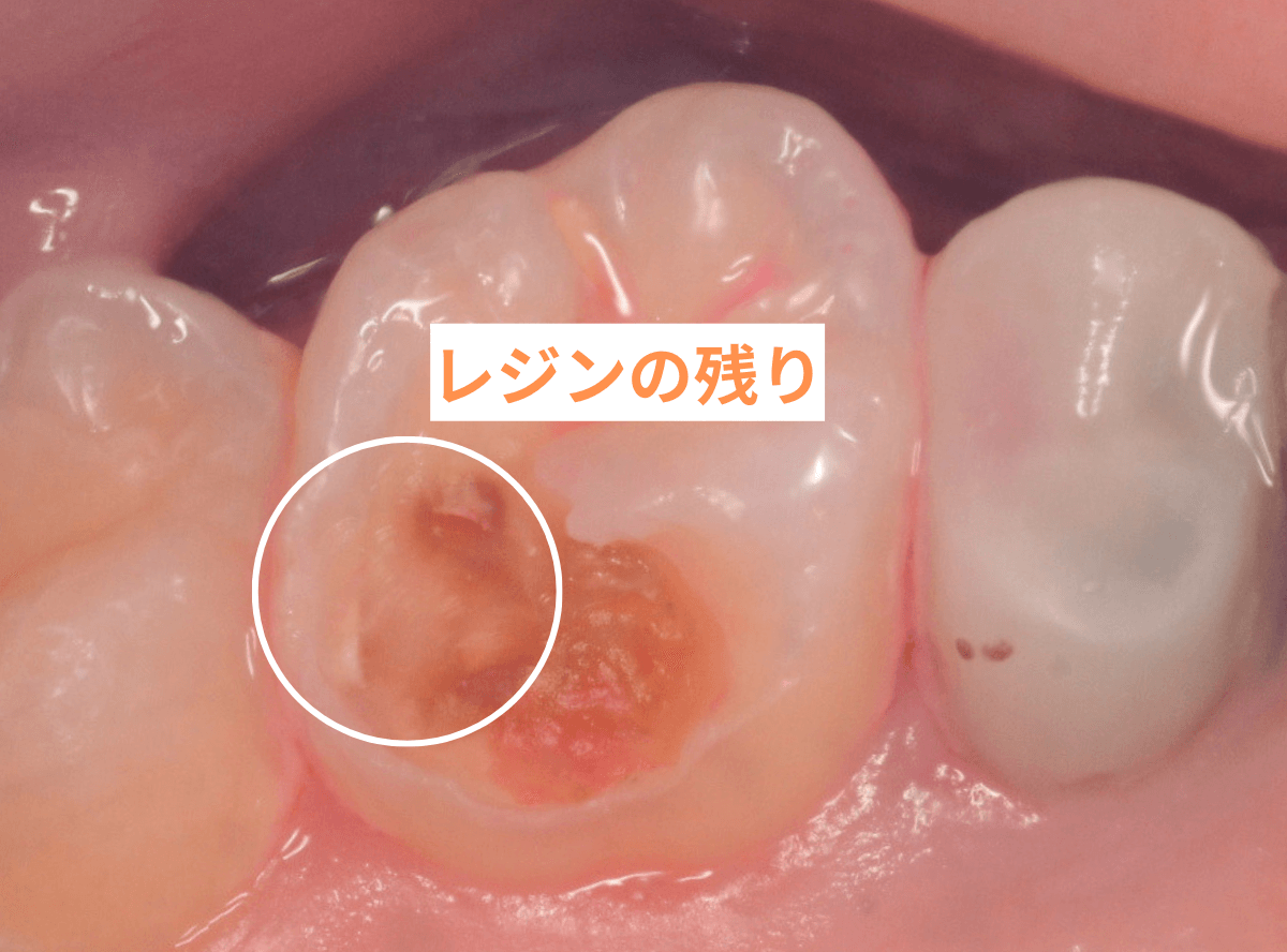レントゲンでわかりづらい虫歯1-5
