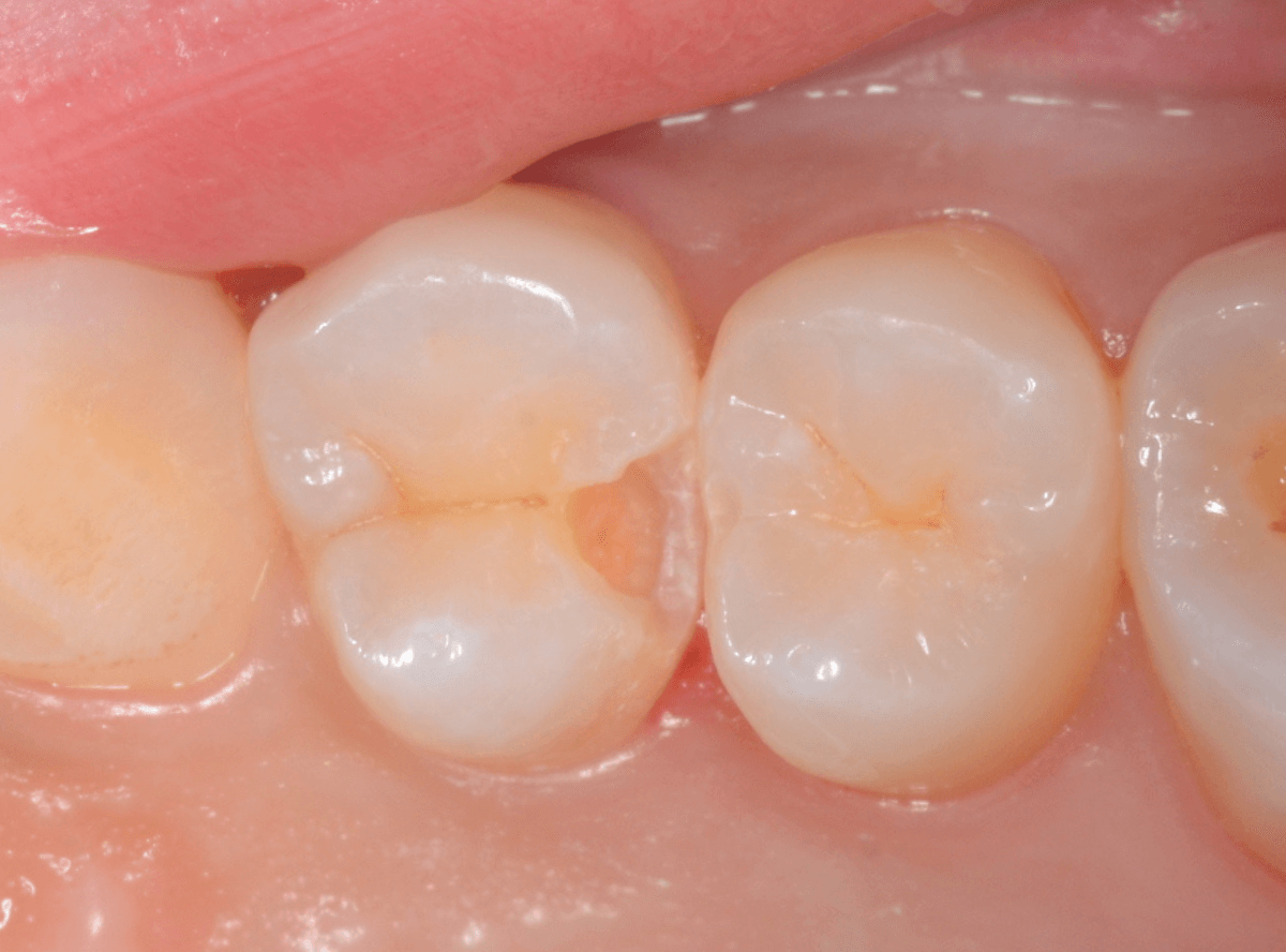 他の歯医者さんで虫歯と言われなかった虫歯の話(画像)5