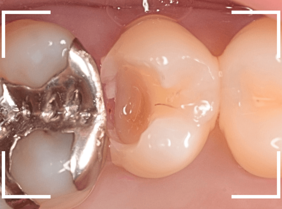歯と歯の間の虫歯10-5