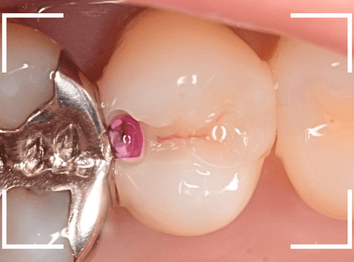 歯と歯の間の虫歯10-3