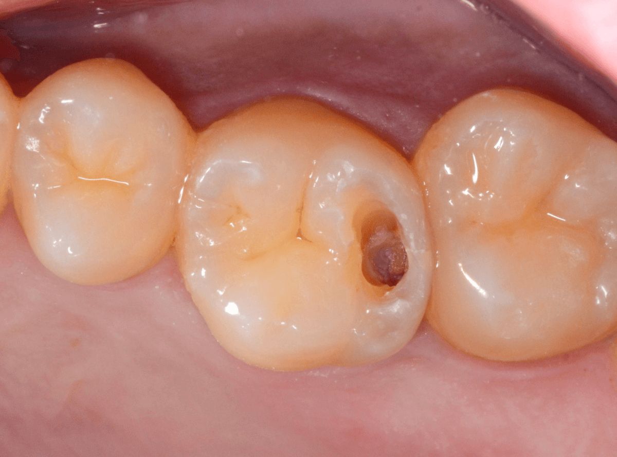 歯と歯の間の虫歯1-3
