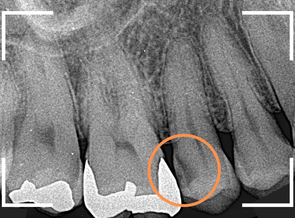 歯と歯の間の虫歯10-1
