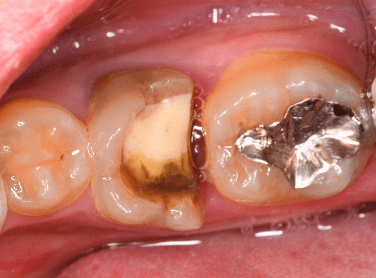 つめものが取れた歯の治療の画像-1