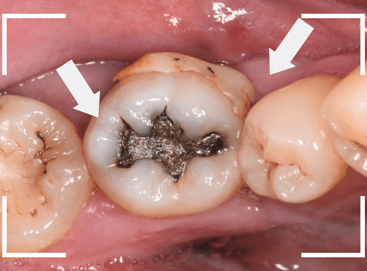 つめものの下の深い虫歯(画像)12-2