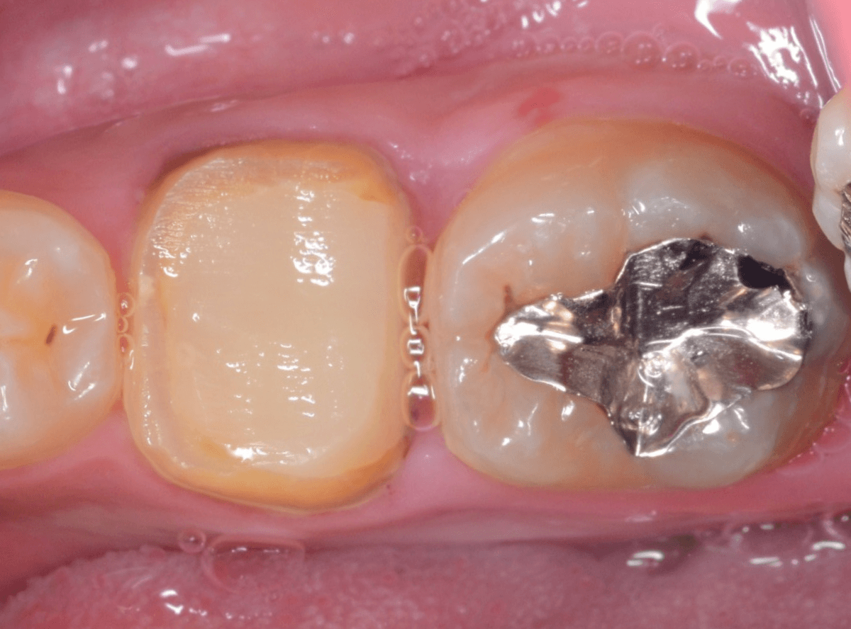 つめものが取れた歯の治療の画像-6