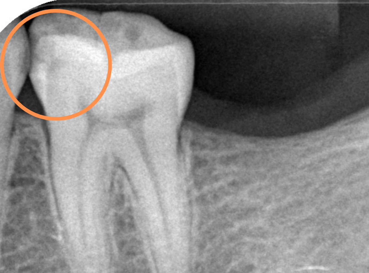 歯と歯の間の虫歯5-2