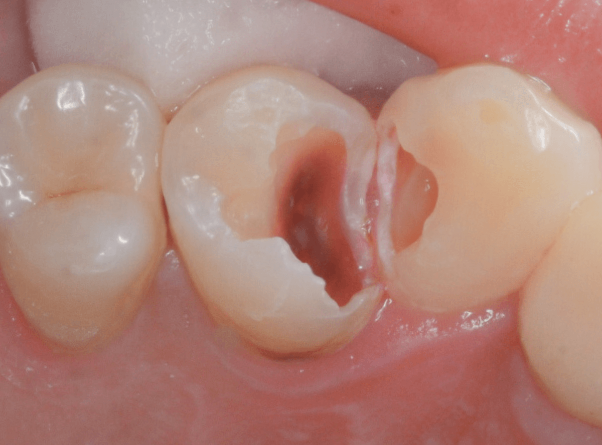 歯と歯の間の虫歯2-3