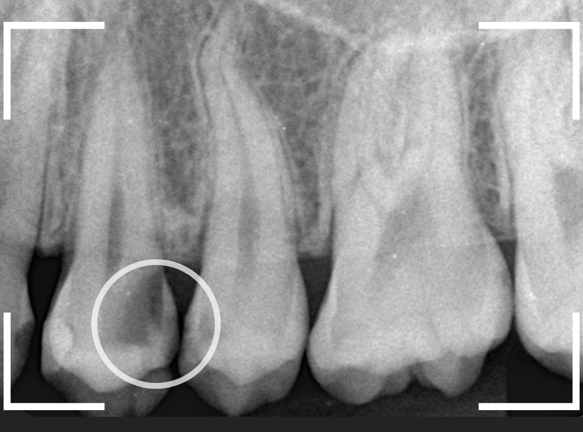 歯と歯の間の虫歯9-2