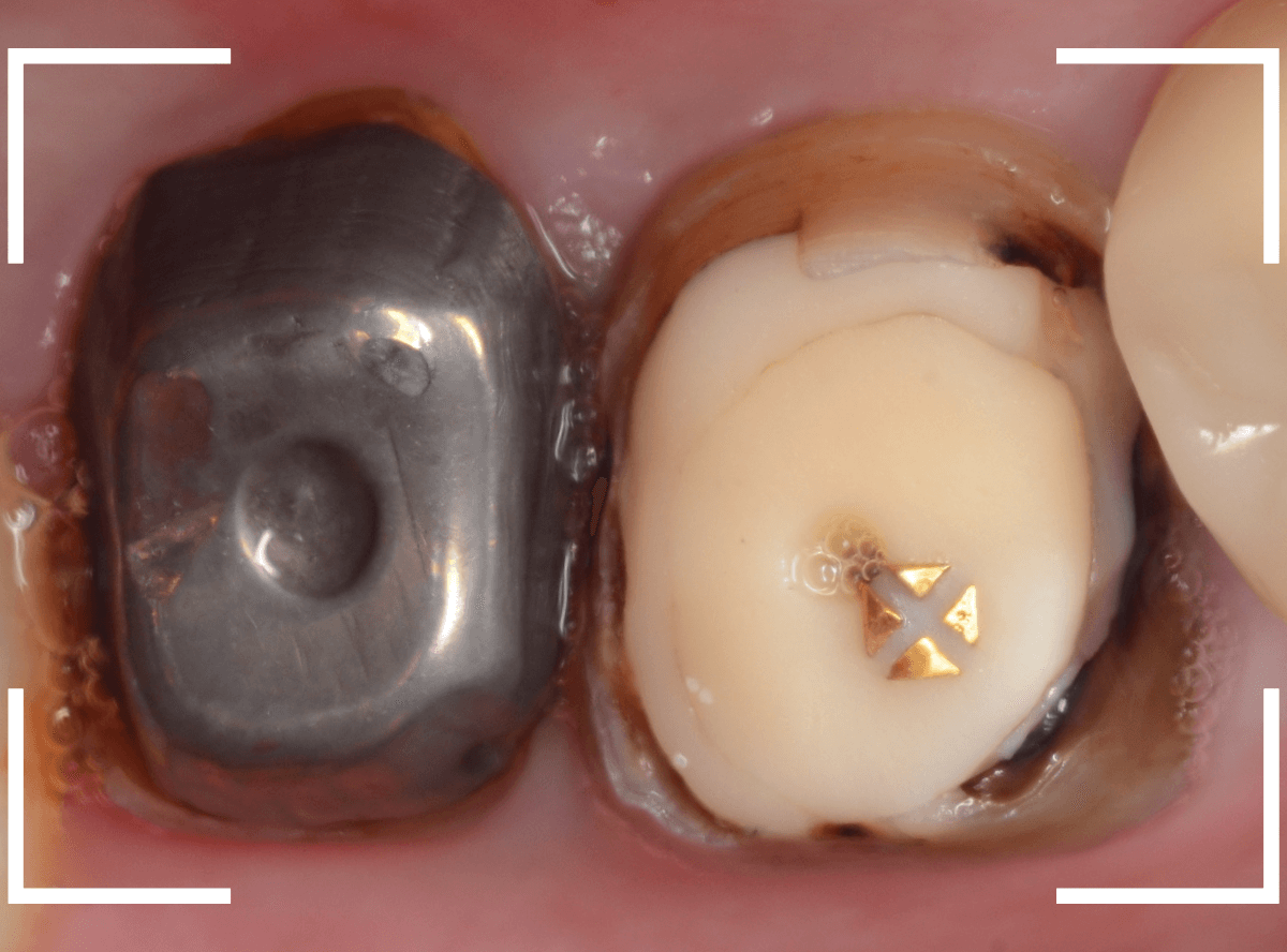 歯の土台の再治療3-1