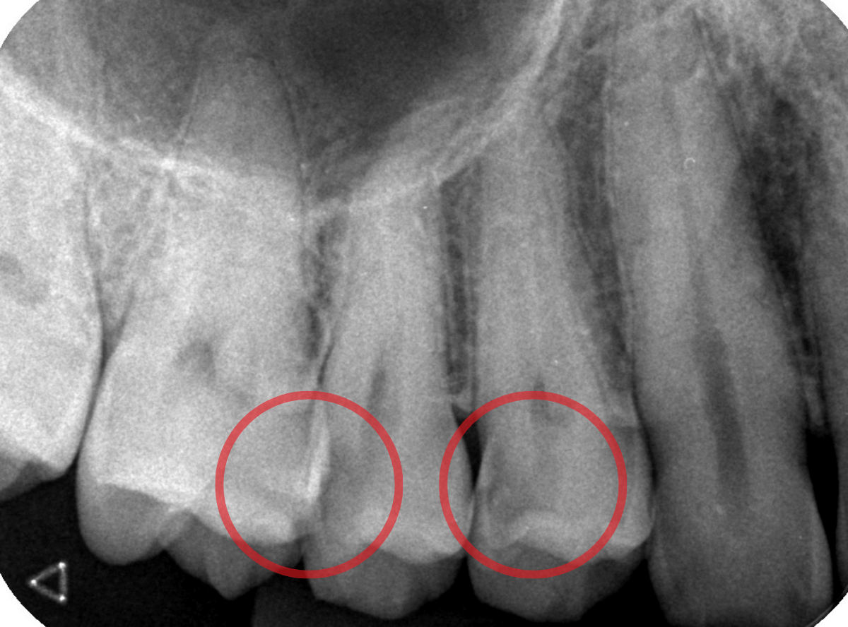 歯と歯の間の虫歯3-2