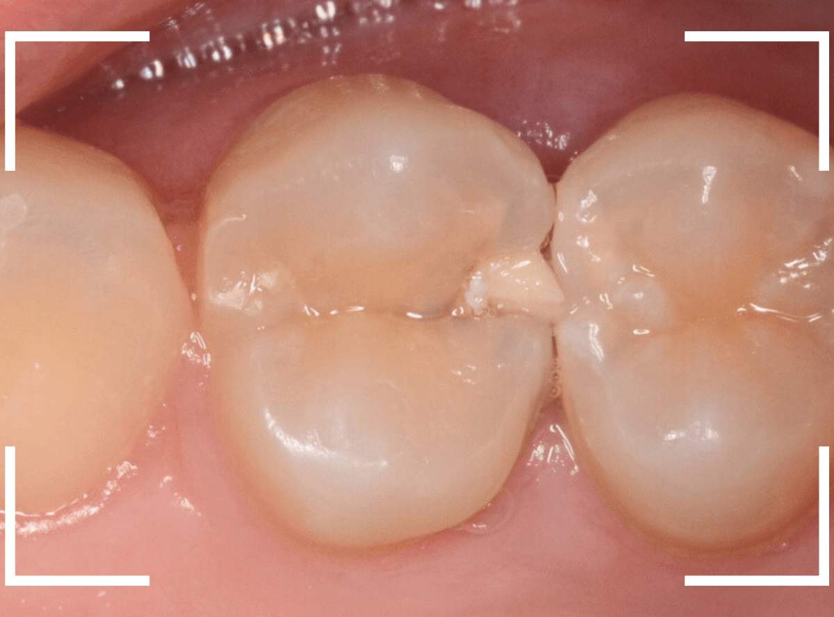 歯と歯の間の虫歯9-1