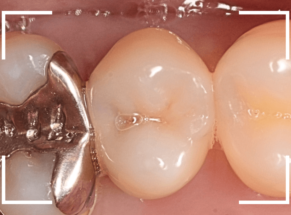 歯と歯の間の虫歯10-2
