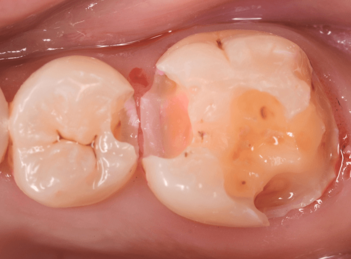 歯と歯の間の虫歯5-6