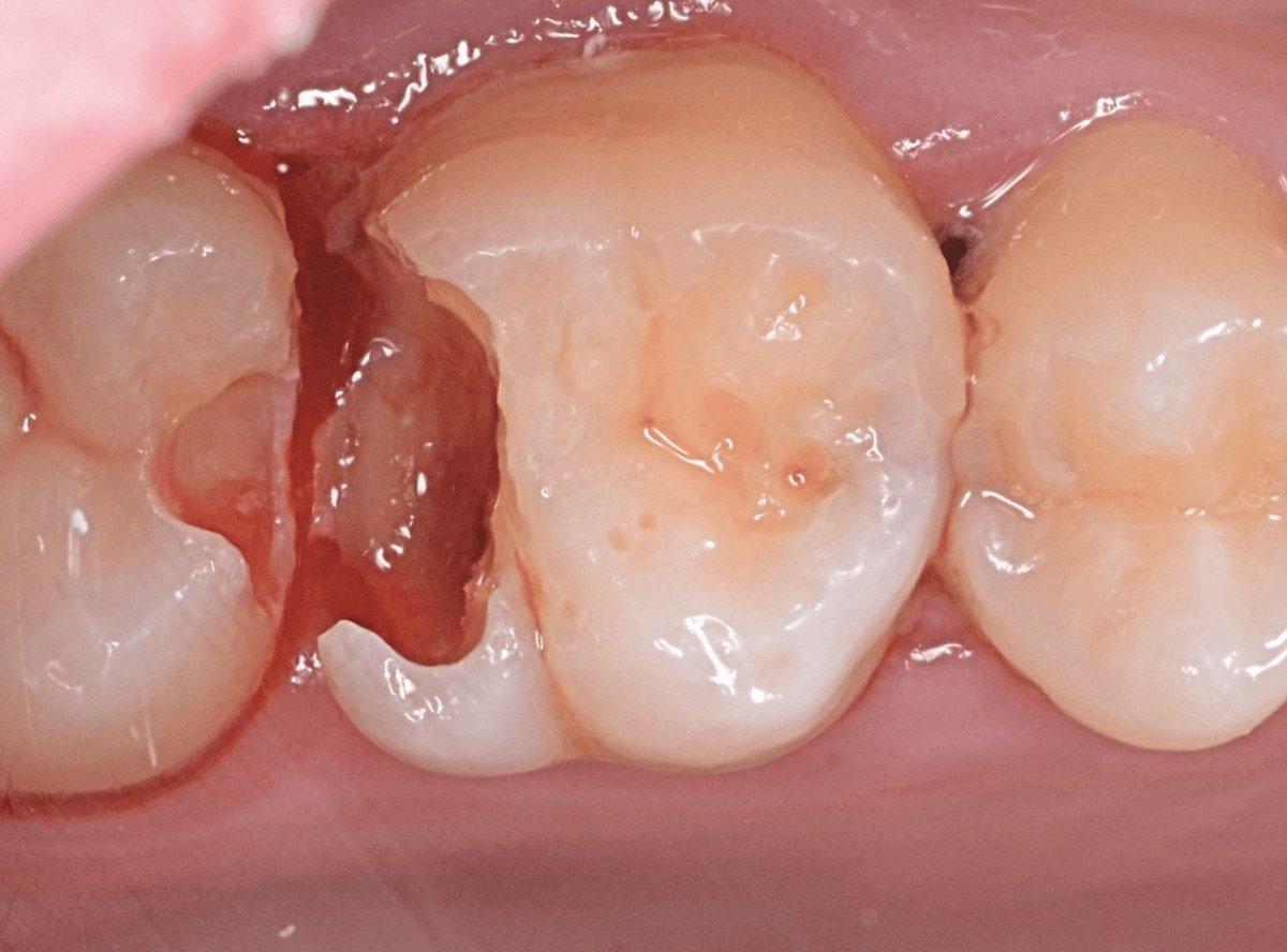歯と歯の間の虫歯4-4