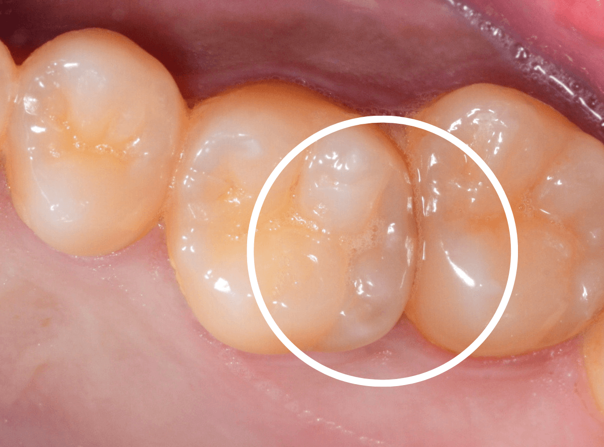 歯と歯の間の虫歯1-1