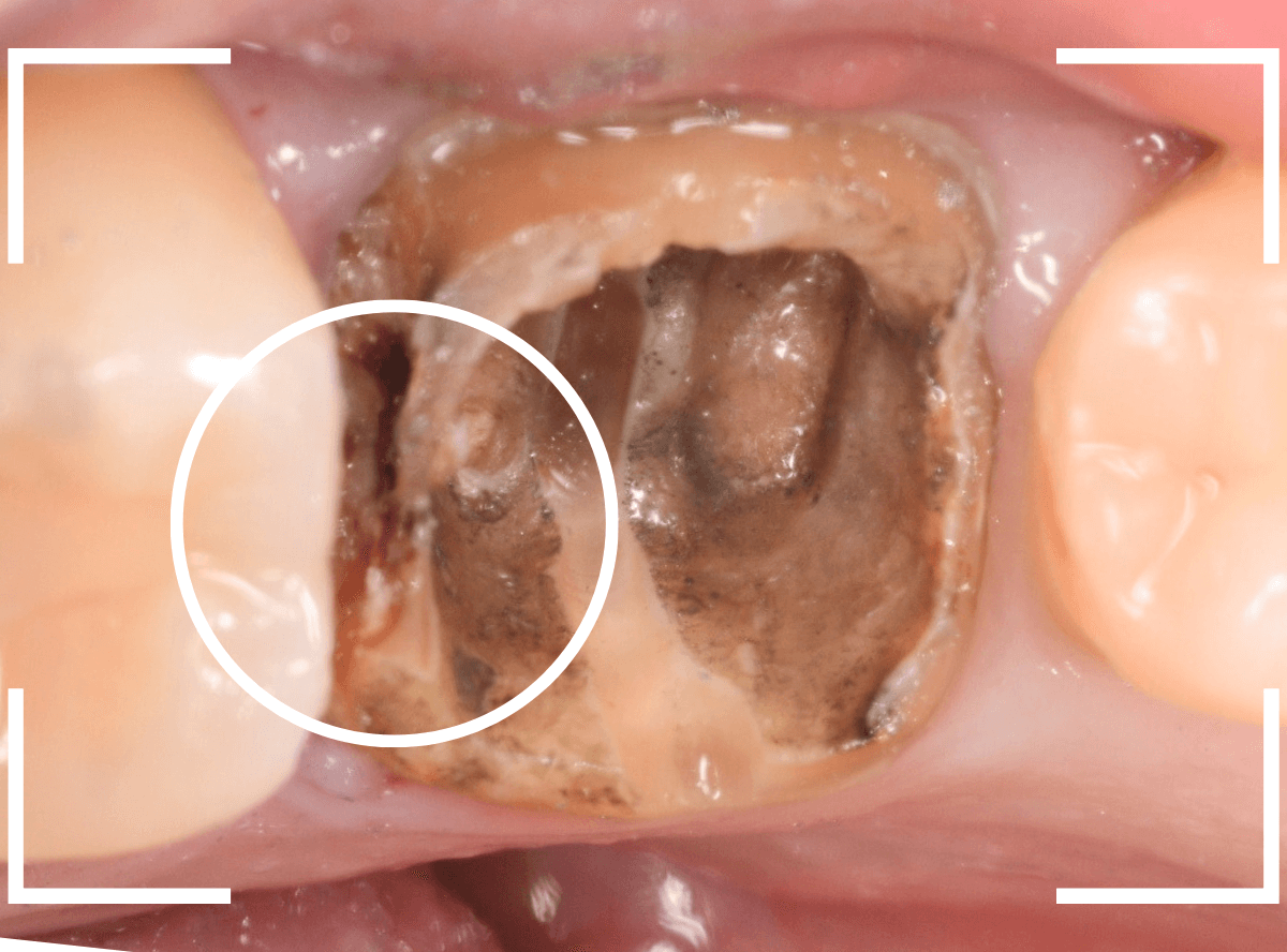 歯の土台の再治療1-3