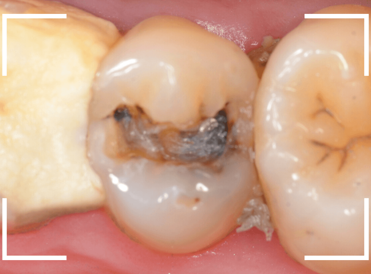 歯と歯の間の虫歯8-2