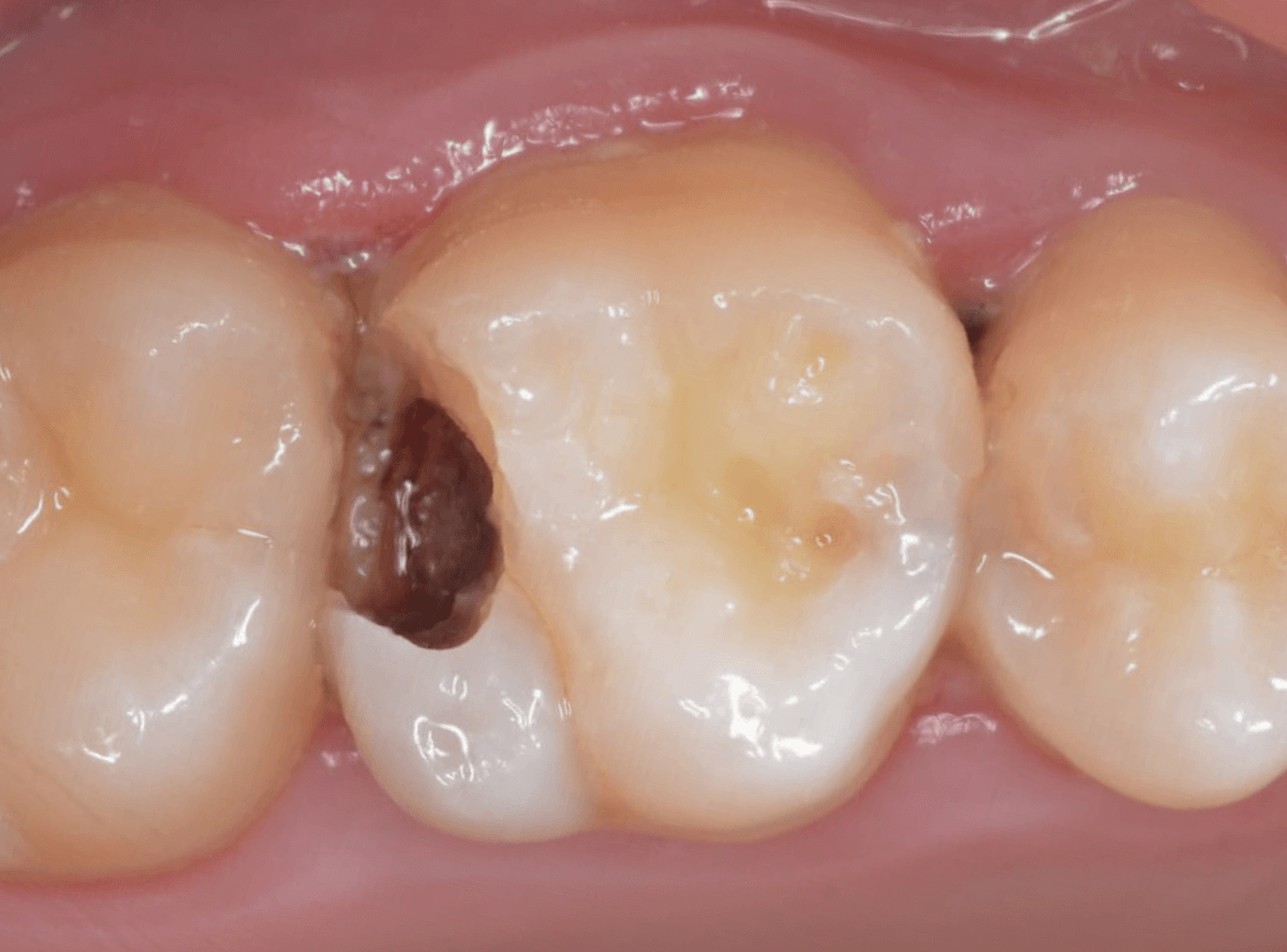 歯と歯の間の虫歯4-3
