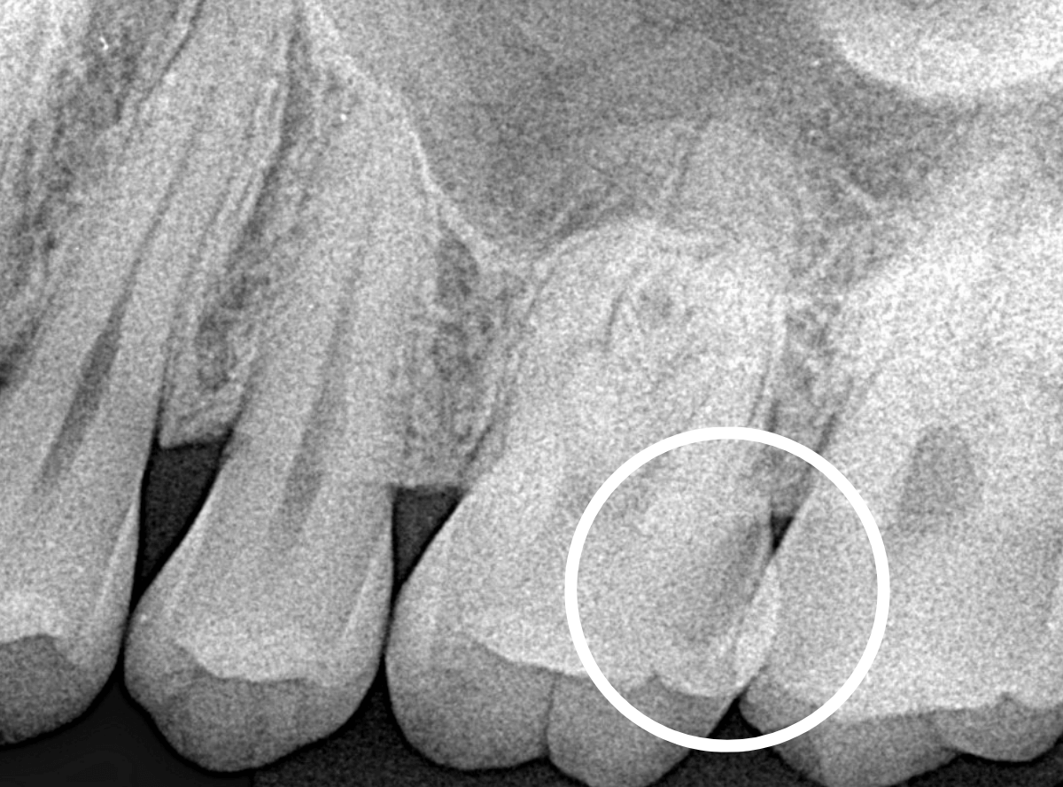 歯と歯の間の虫歯1-2