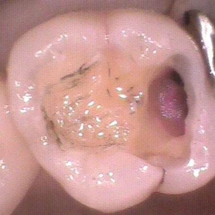 虫歯の治療ケース1(治療中3）