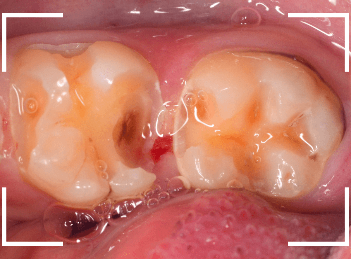 歯と歯の間の虫歯13-7