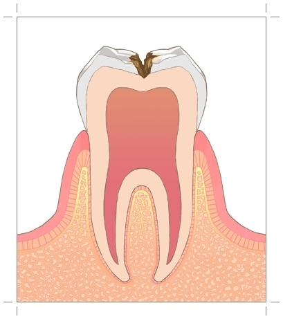 虫歯(C2)