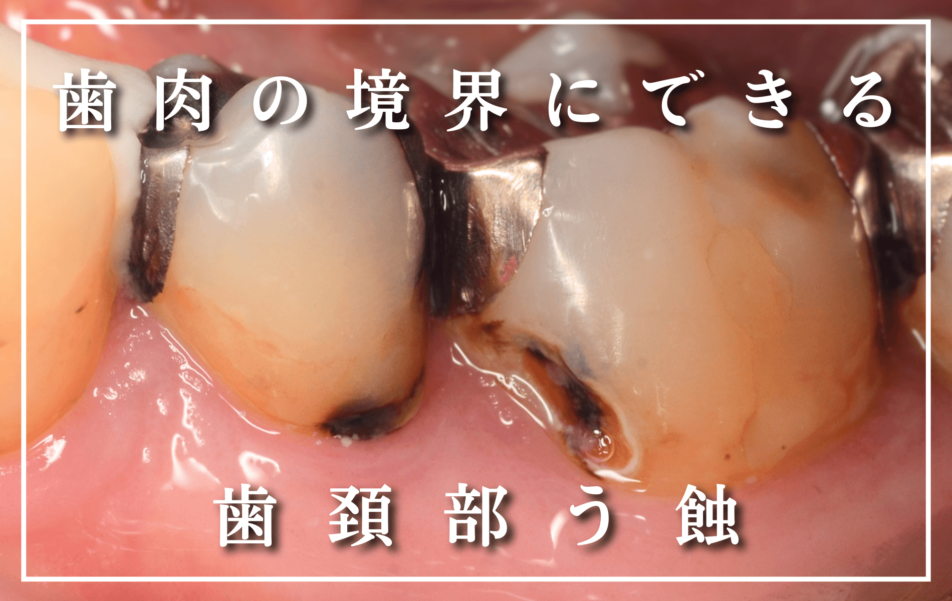 歯頚部う蝕とは?