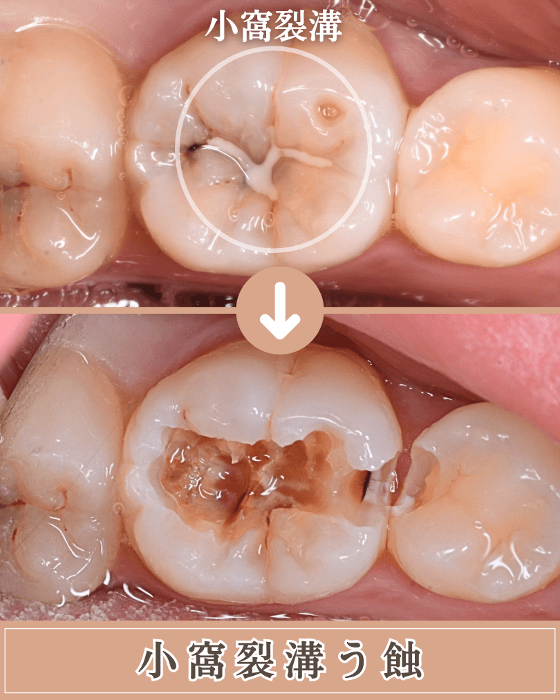 小窩裂溝う蝕の画像
