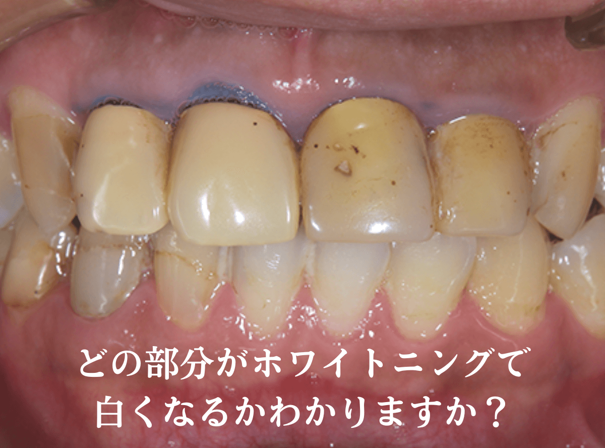ホワイトニング可能な歯とは？