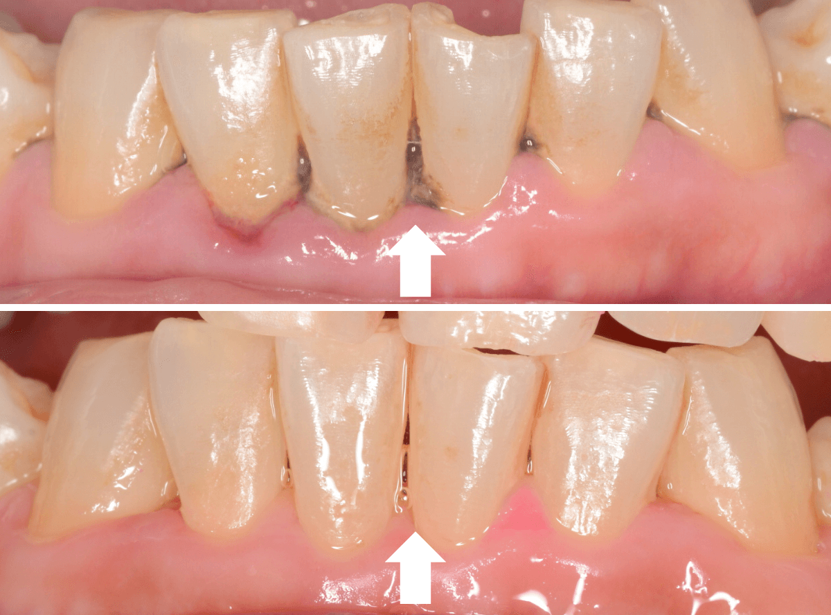 歯肉の中の歯石（歯肉縁下歯石）除去(画像）3-1