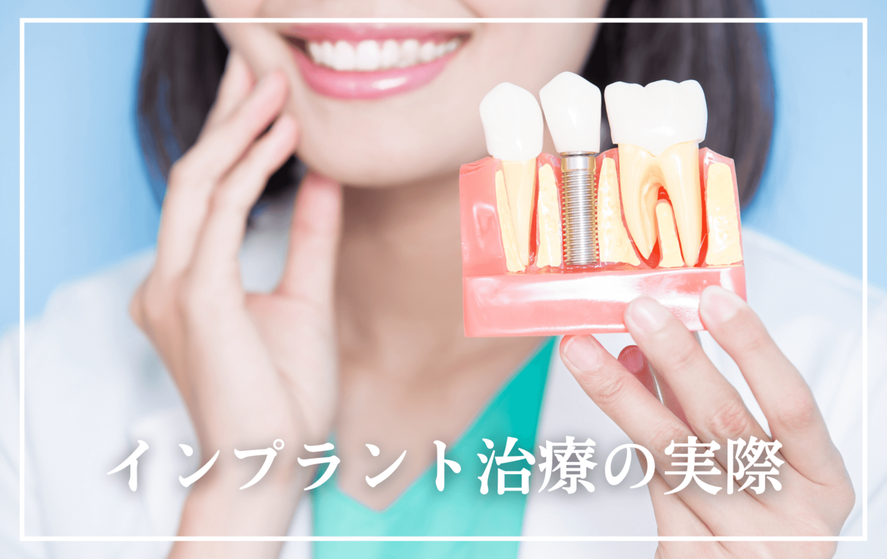 インプラント治療の実際
