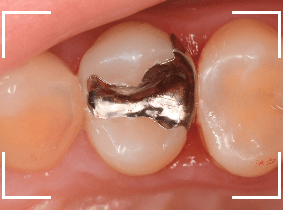歯と歯の間の虫歯7-4