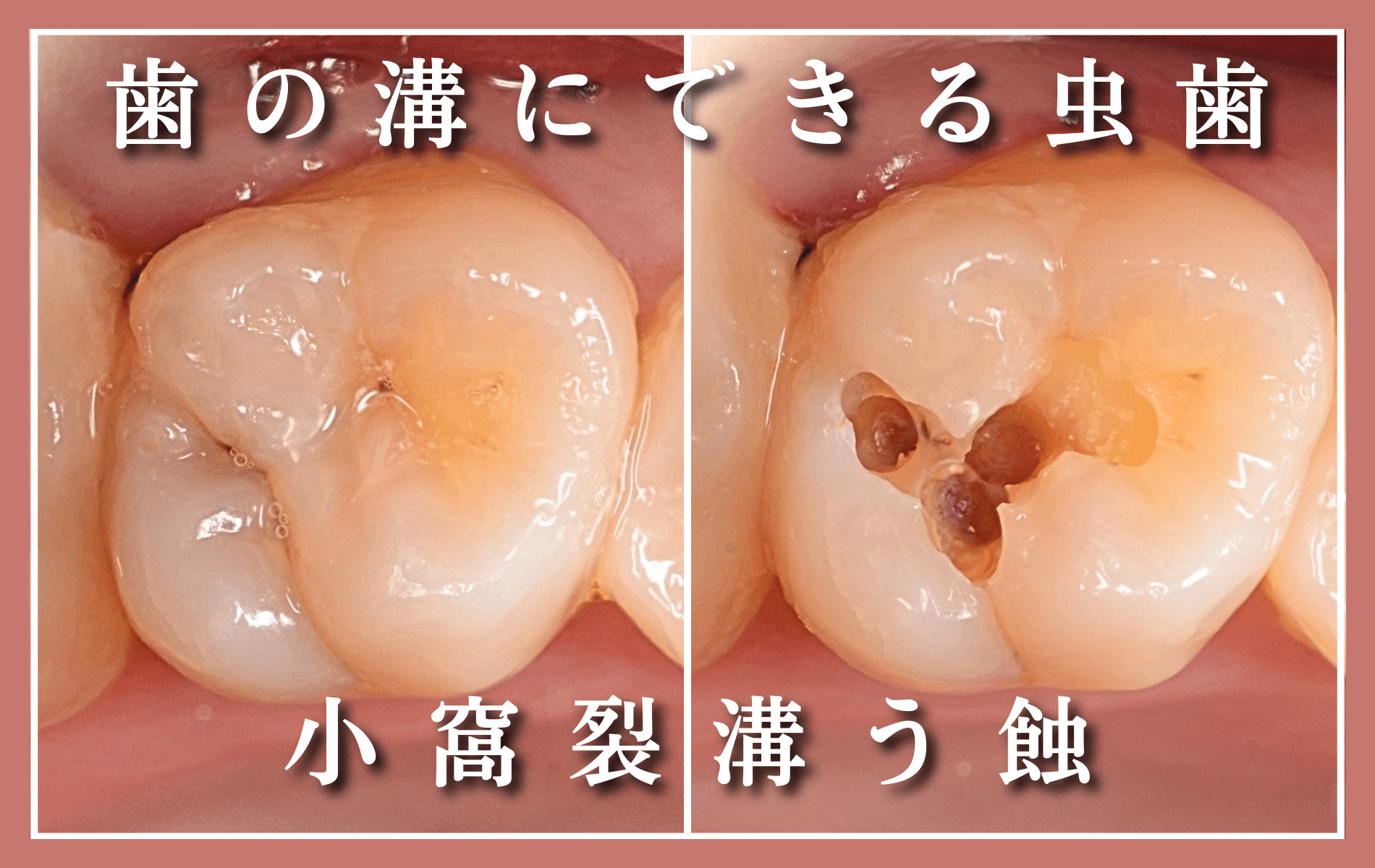 小窩裂溝う蝕
