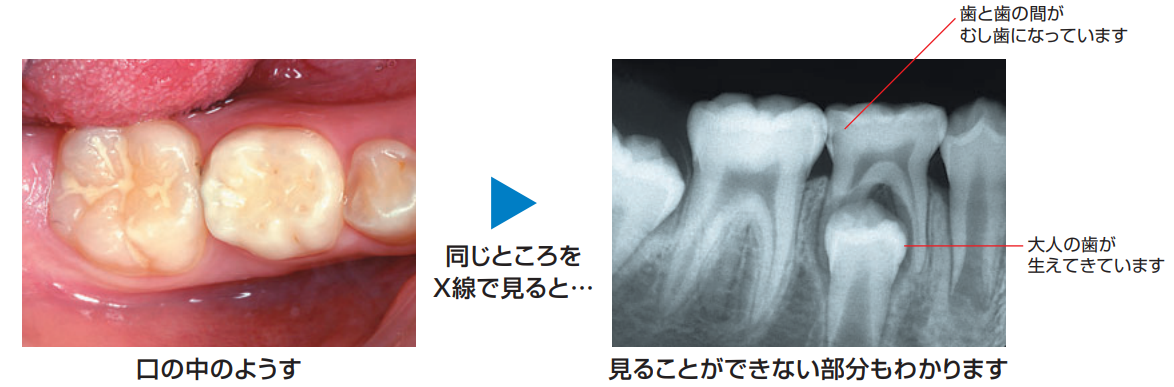 歯の写真とレントゲン写真