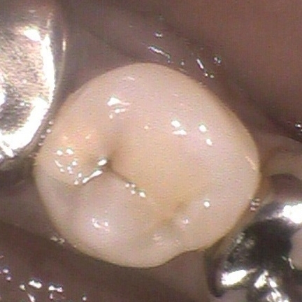 虫歯の治療ケース1(治療前）