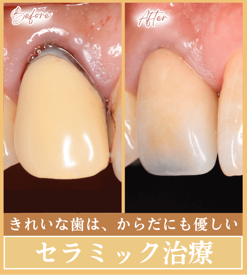 セラミック治療