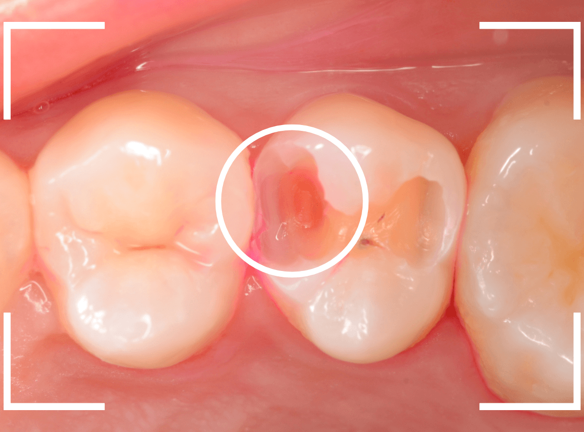 歯と歯の間の虫歯15-4