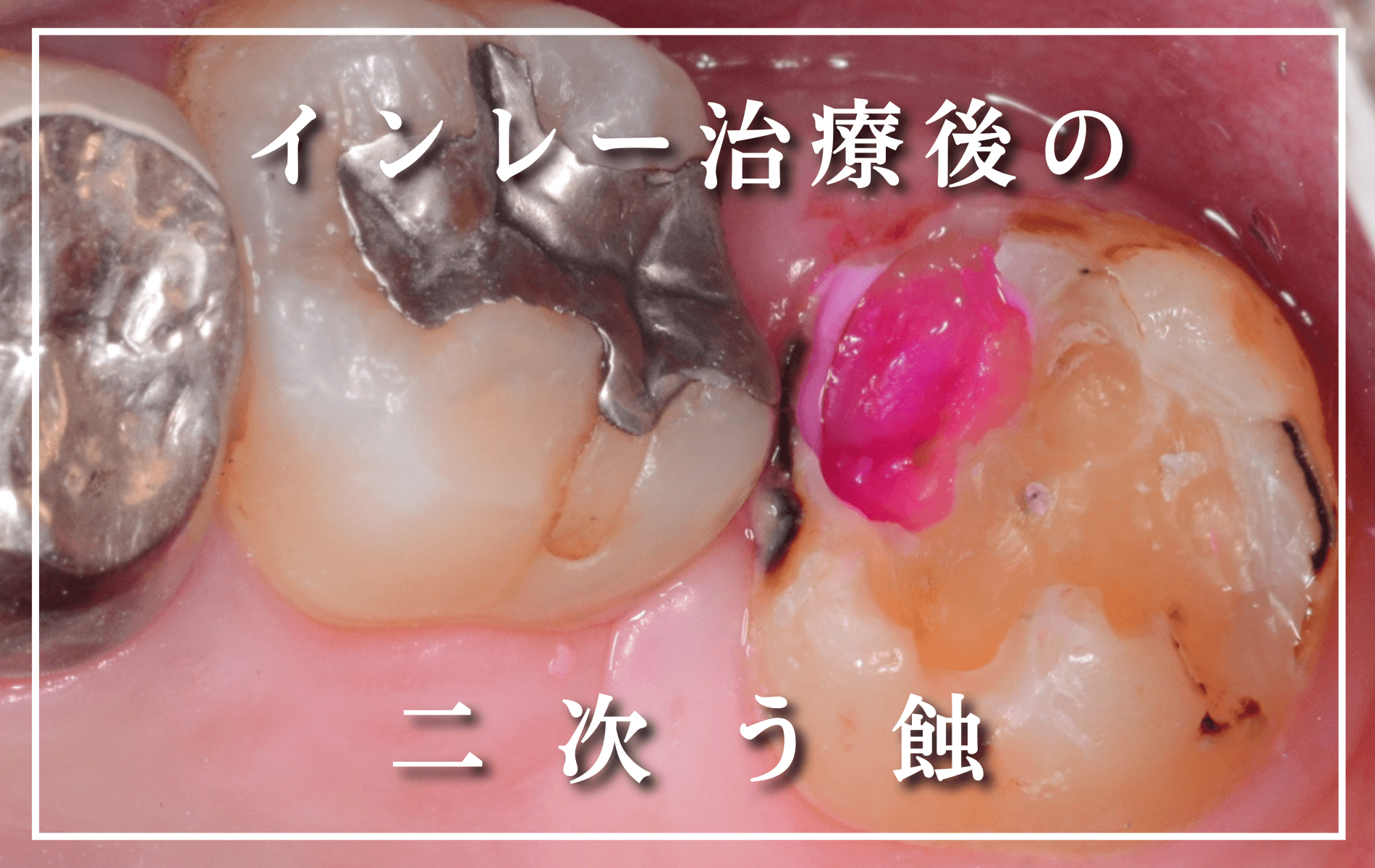 つめものの下の深い虫歯(画像)-タイトル