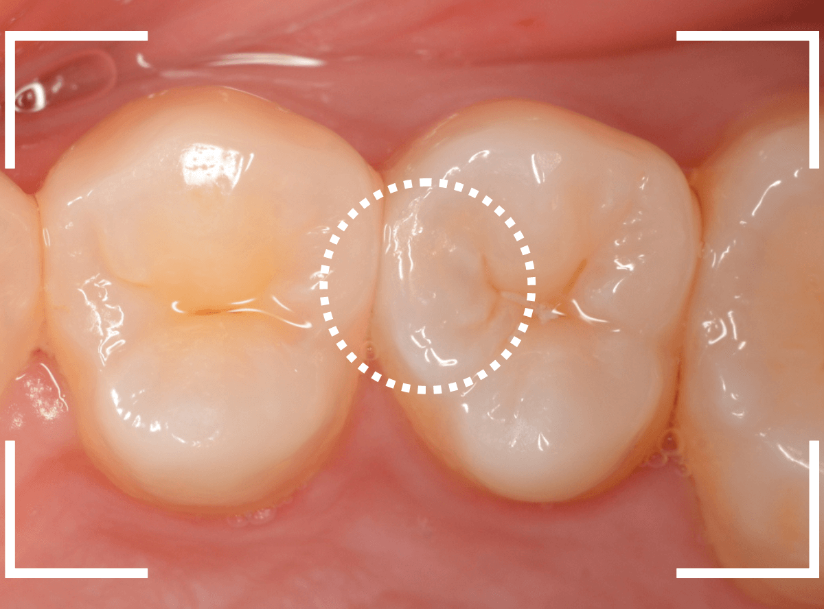 歯と歯の間の虫歯15-1
