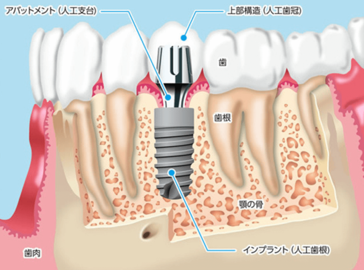 インプラントとは？