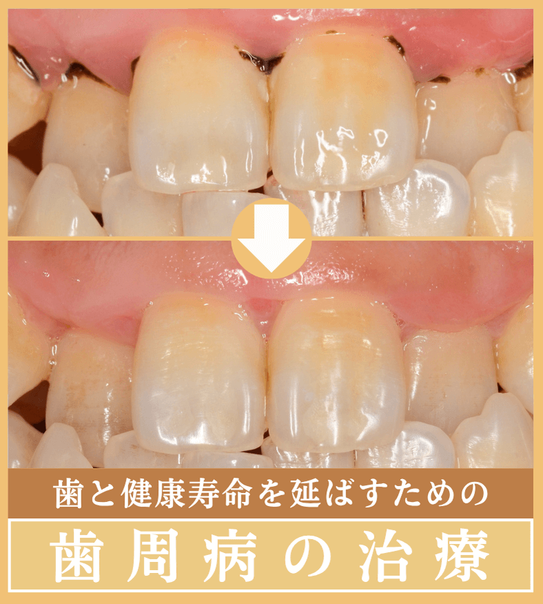 歯周病の治療