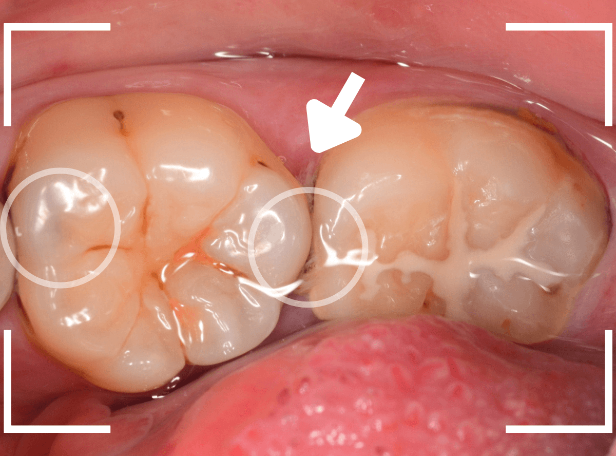 歯と歯の間の虫歯13-5