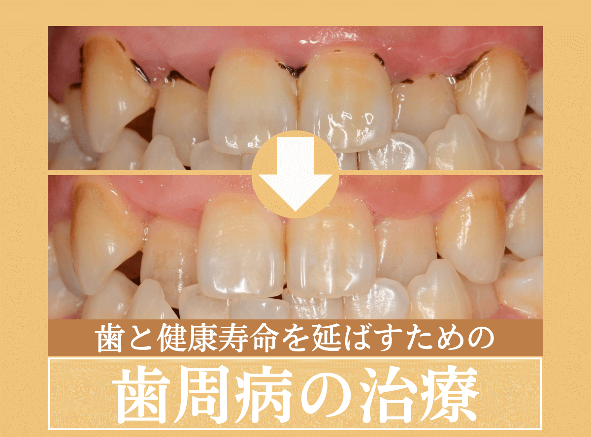 歯周病の治療のリンク