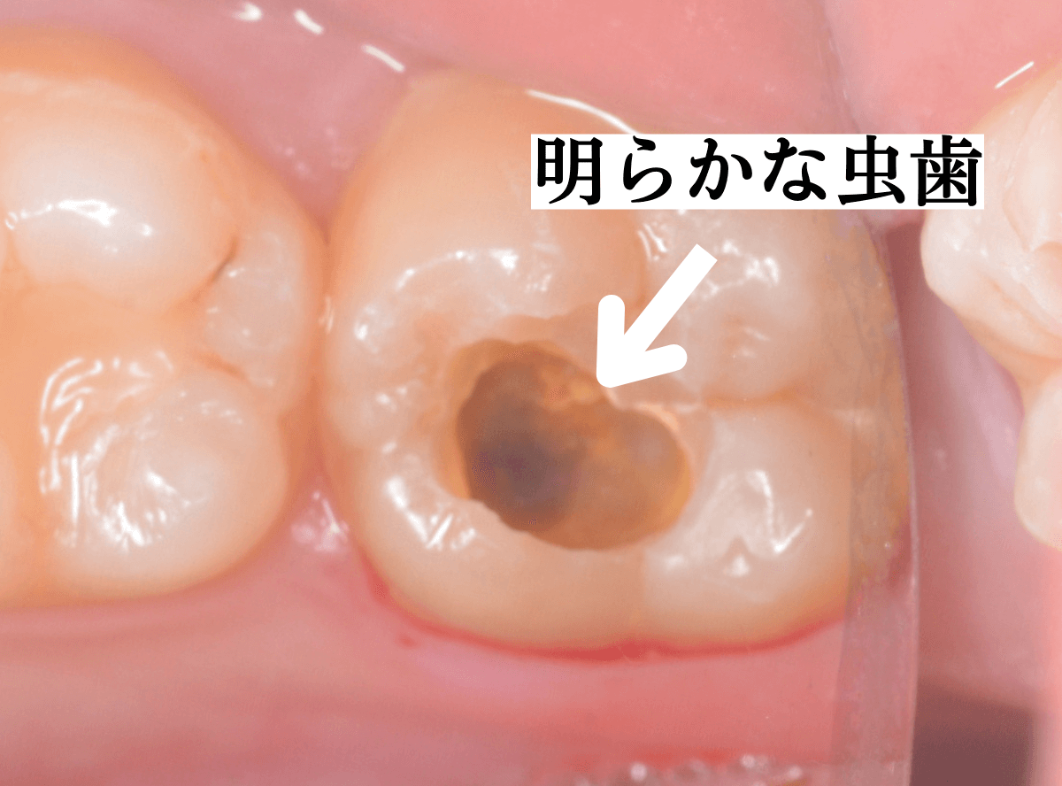 つめものの下の深い深い虫歯1-4