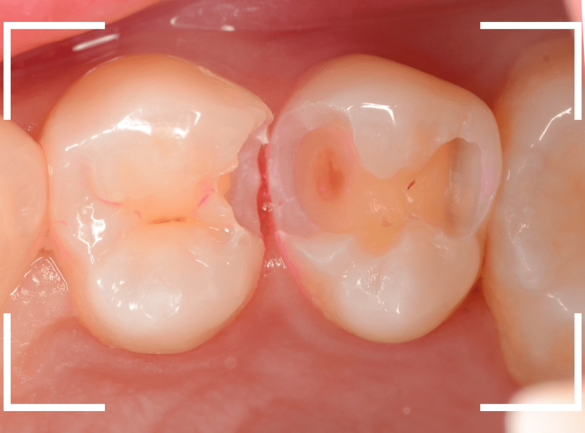 歯と歯の間の虫歯15-5