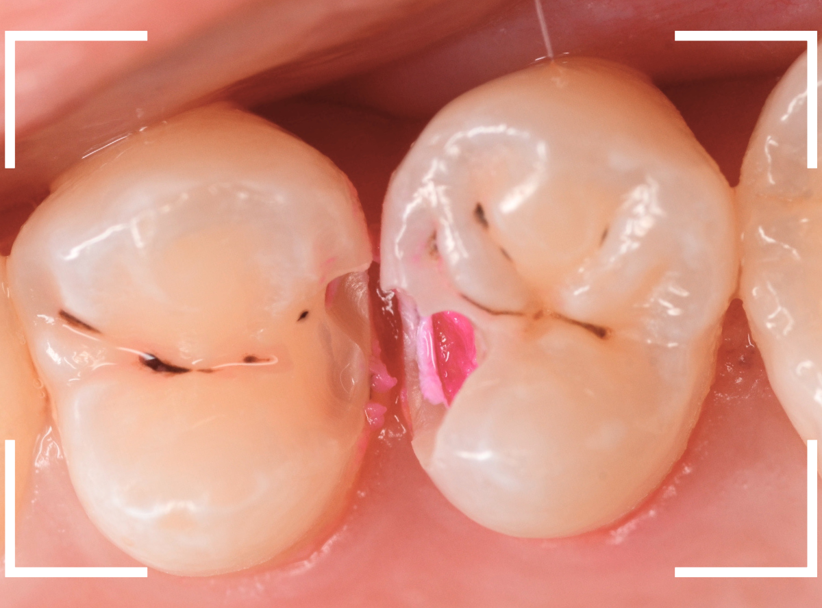 歯と歯の間の虫歯11-3