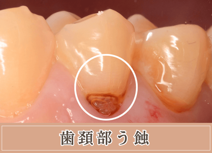歯頚部う蝕の画像