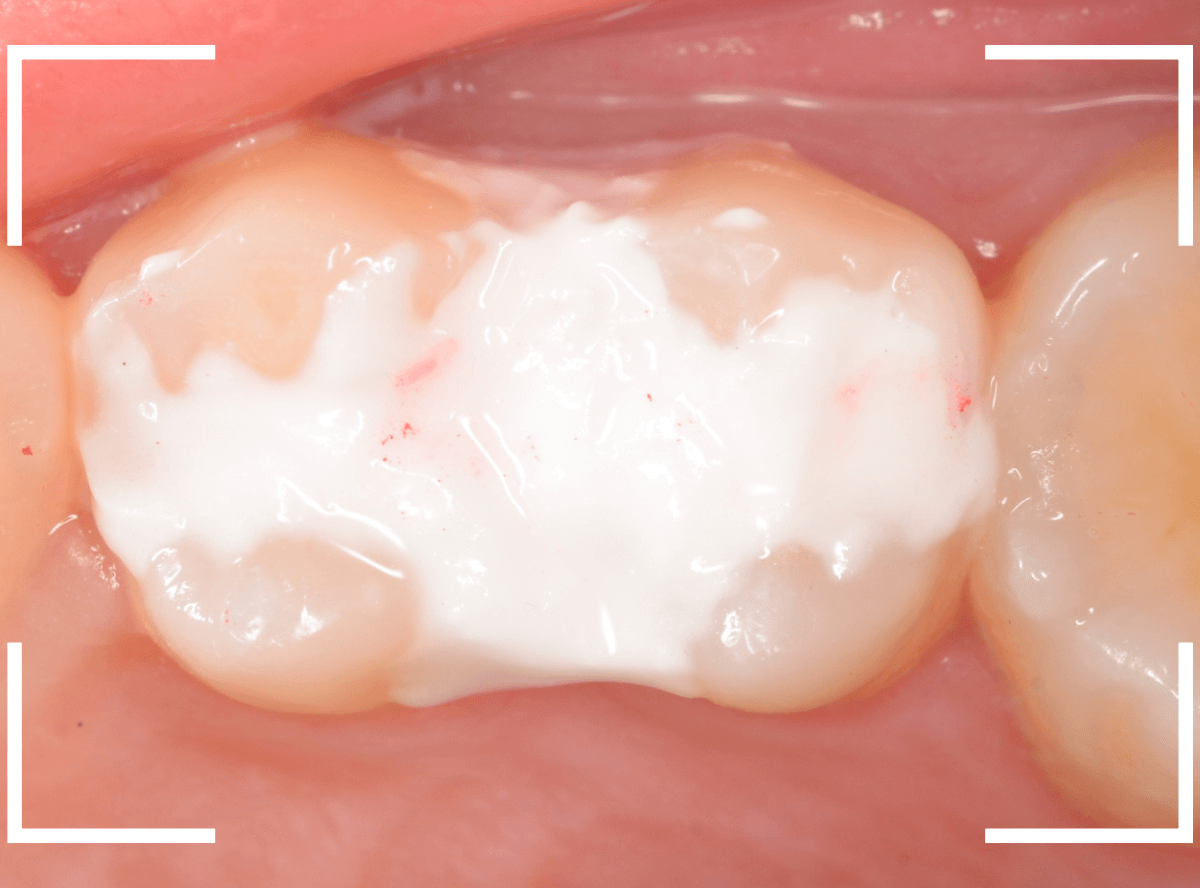 歯と歯の間の虫歯15-6