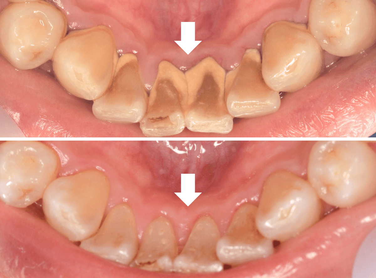 歯肉の中の歯石（歯肉縁下歯石）除去(画像）3-2