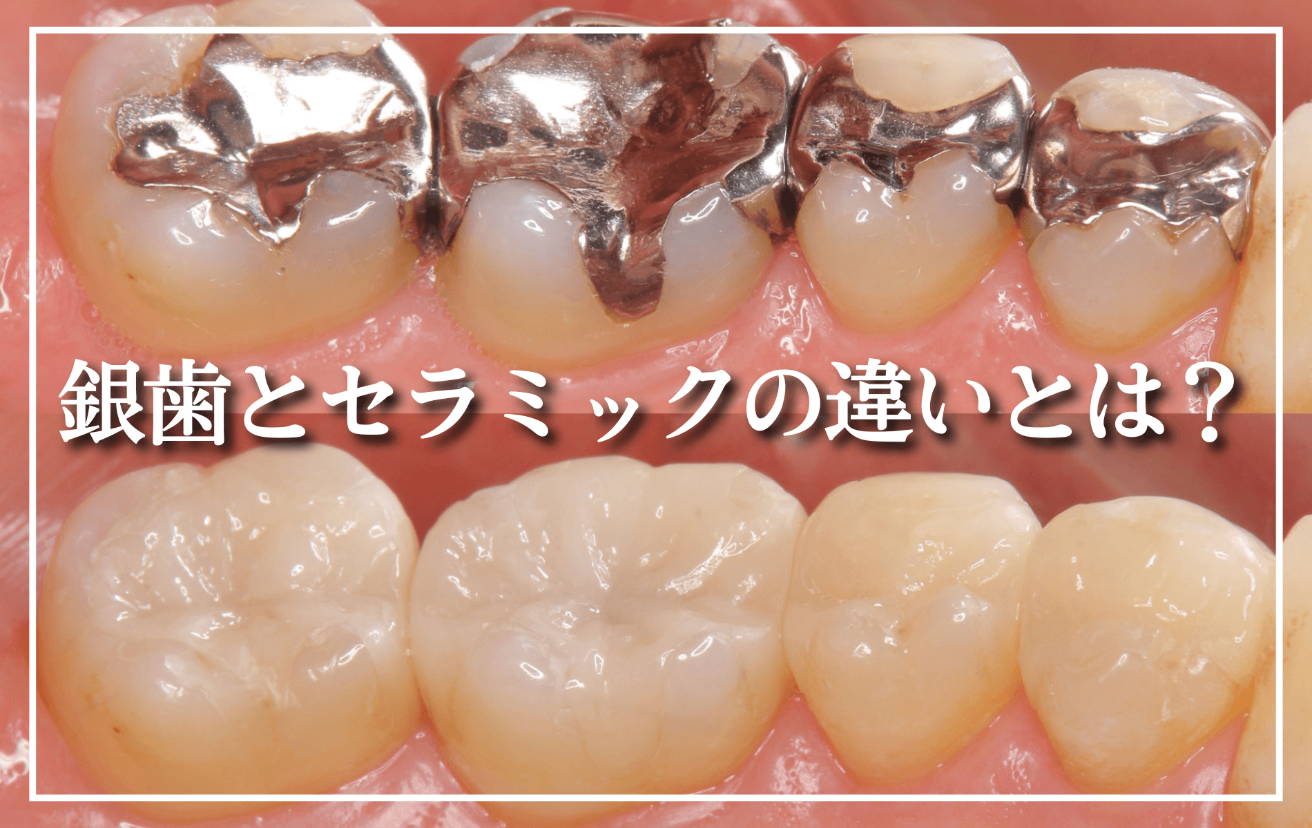 銀歯とセラミックの違いとは?トップ画像